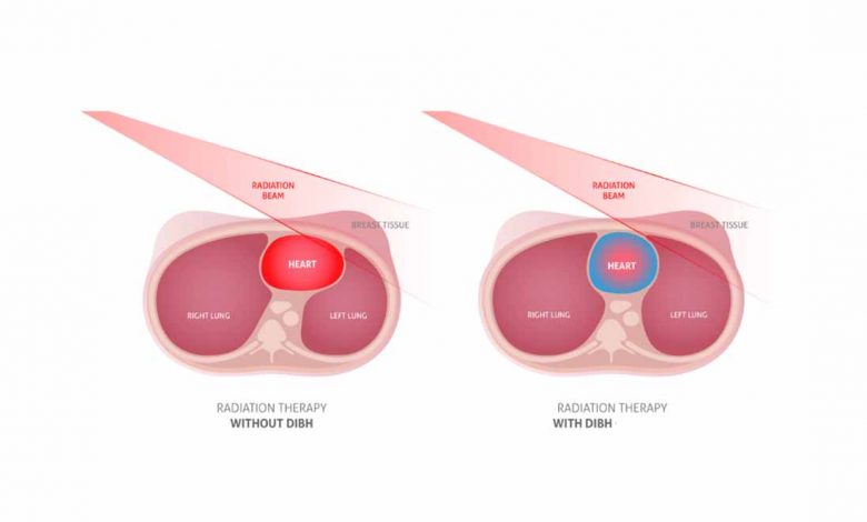 Deep Inspiratory Breath Hold (DIBH) is a game changing modern technique in Breast Cancer Radiotherapy